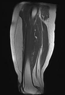 Lipoma Thigh MRI